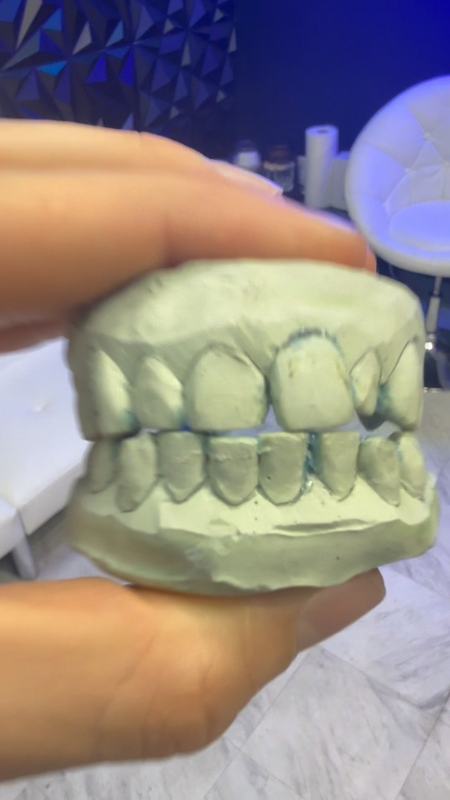 Fresh dental mold in a gloved hand